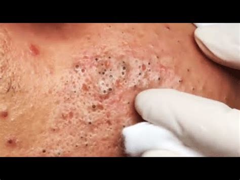 If youre in need of a lesson in perseverance, look no further than Dr. . Ga spa blackheads